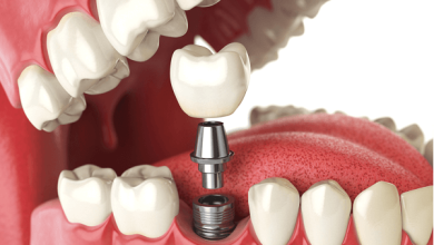 What Patients Should Know About Dental Implants