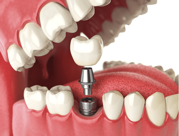 What Patients Should Know About Dental Implants